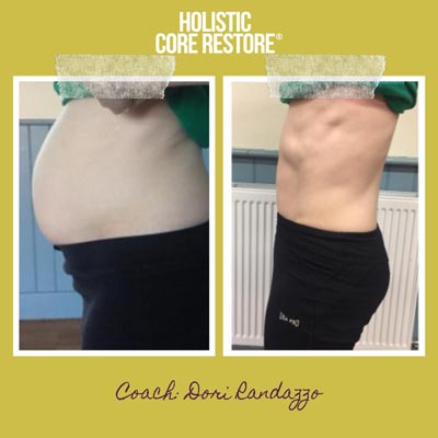 Before & After Diastasis Recti Repair Gallery - Holistic Core Restore